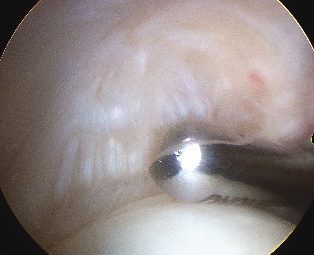 Supraspinatous Normal Arthroscopy